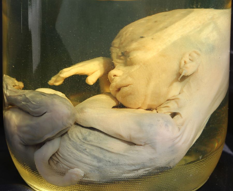 Human Embryo - About 4 1/2 - 5 months